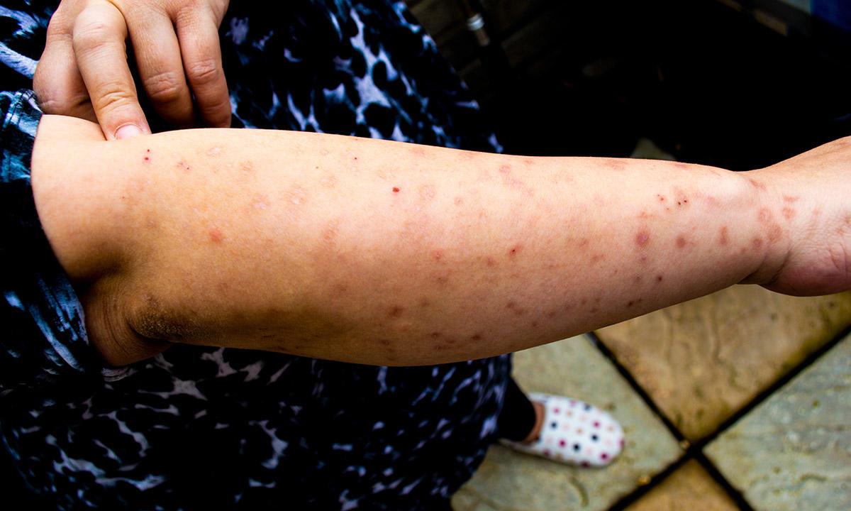 many small red bites all along woman's arm