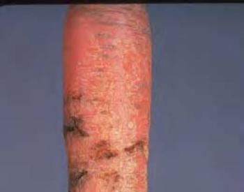 Carrot shows dark marks that are damage from carrot rust flies.
